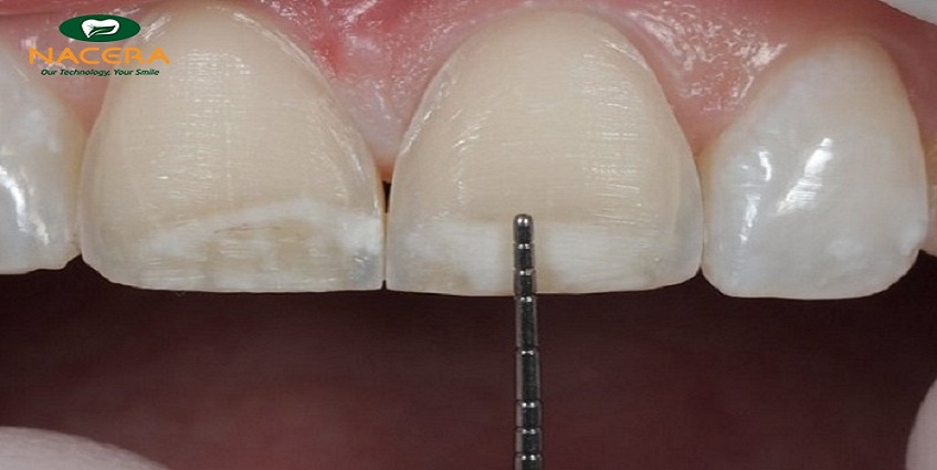 Bạn có đang “hiểu lầm” về phủ răng sứ?